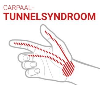 CARPAAL-TUNNELSYNDROOM