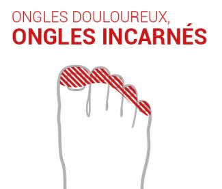 Ongle incarné - ongle cassé