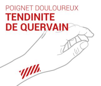 Tendinite de De Quervain