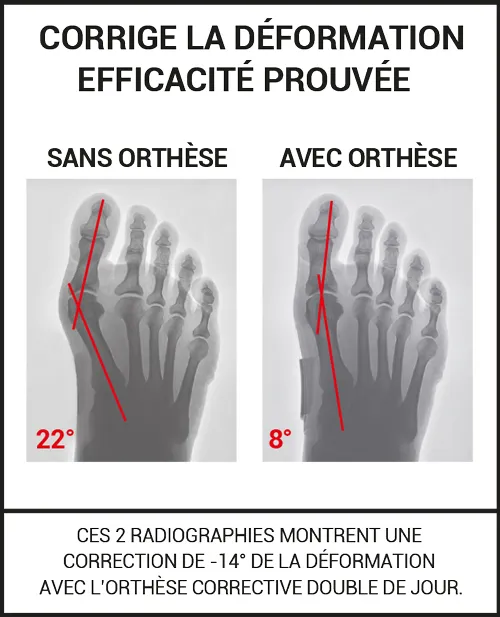 Orthèse corrective double hallux valgus