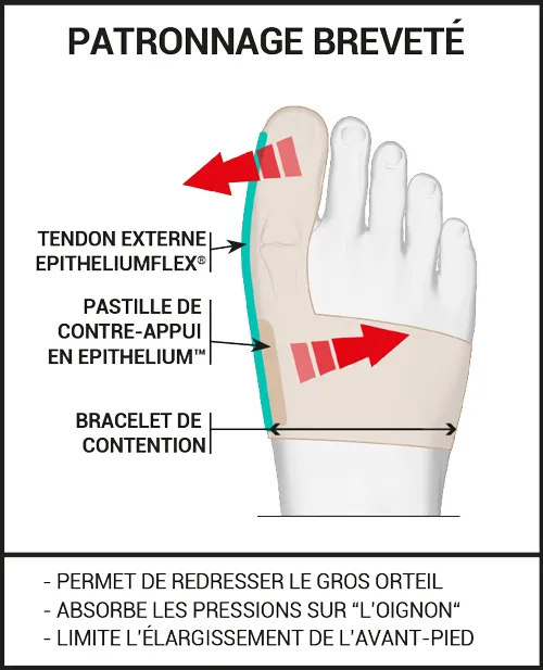 correction avec et sans orthèse hallux valgus EPITACT