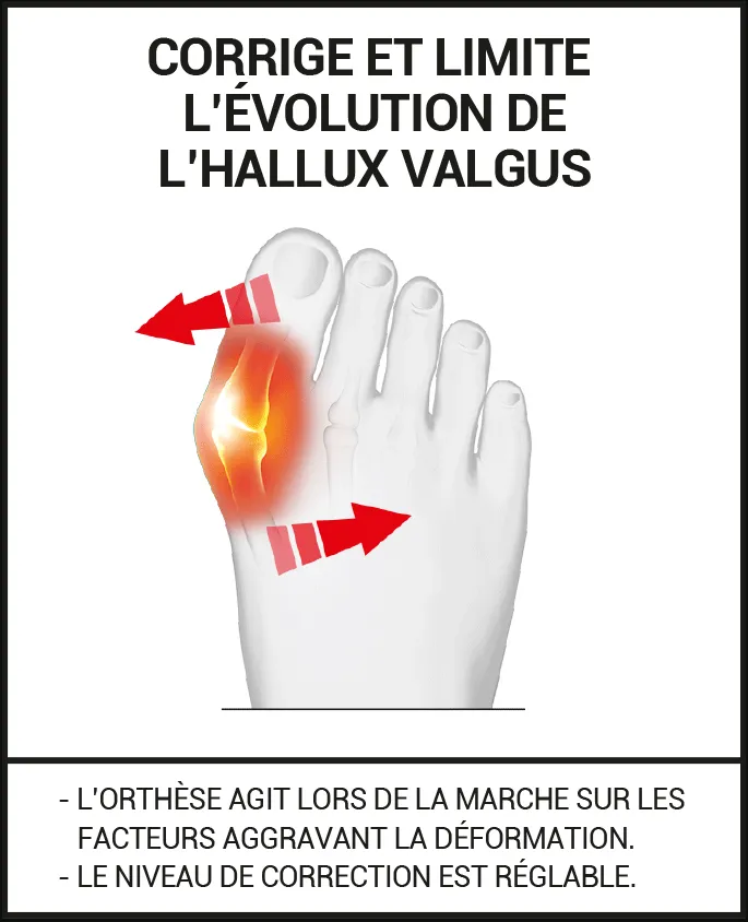 correction avec et sans orthèse hallux valgus EPITACT