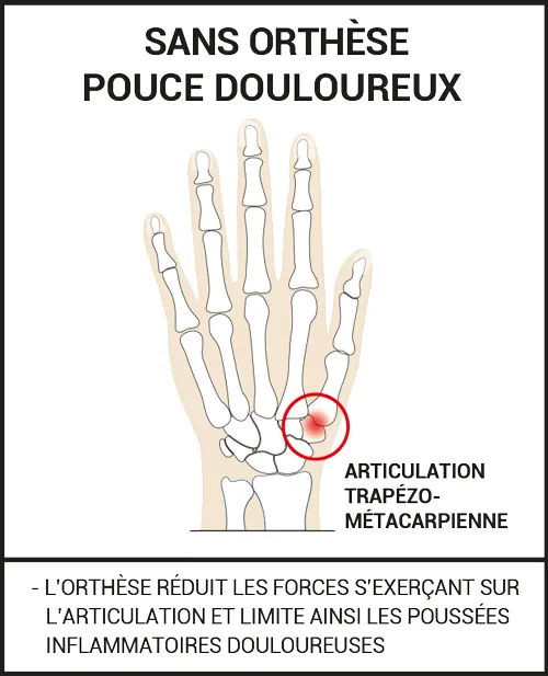Orthèse Rhizarthrose 