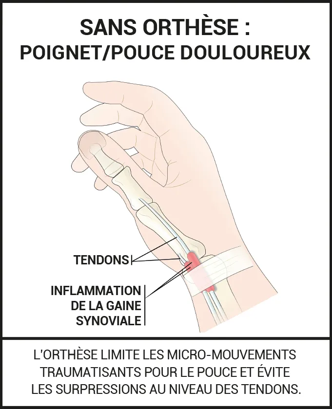 Orthèse ergonomique souple tendinite de De Quervain